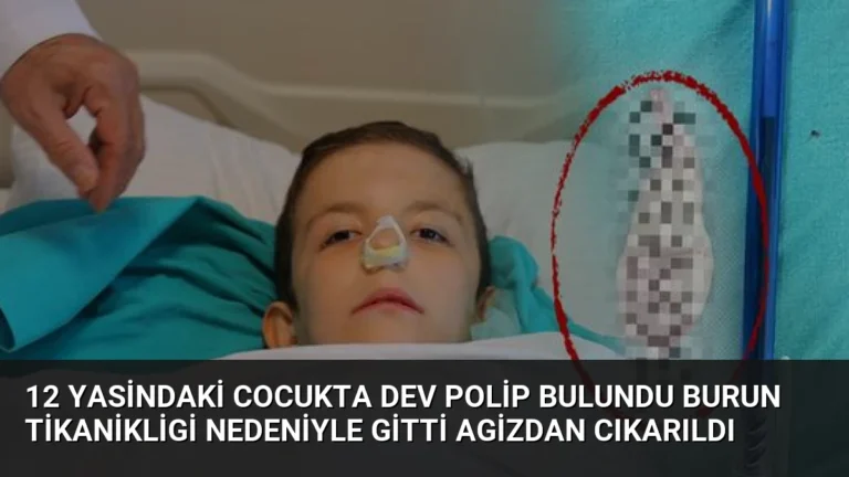 12 Yasindaki Cocukta Dev Polip Bulundu Burun Tikanikligi Nedeniyle Gitti Agizdan Cıkarıldı